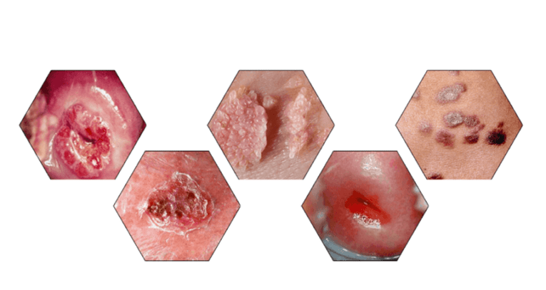 Prečo sú papilómy nebezpečné