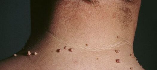 ako sa zbaviť papilómov