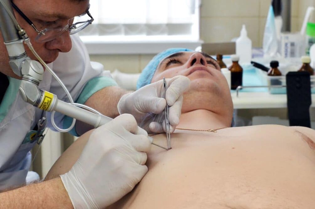 ako sa zbaviť bradavíc na tele