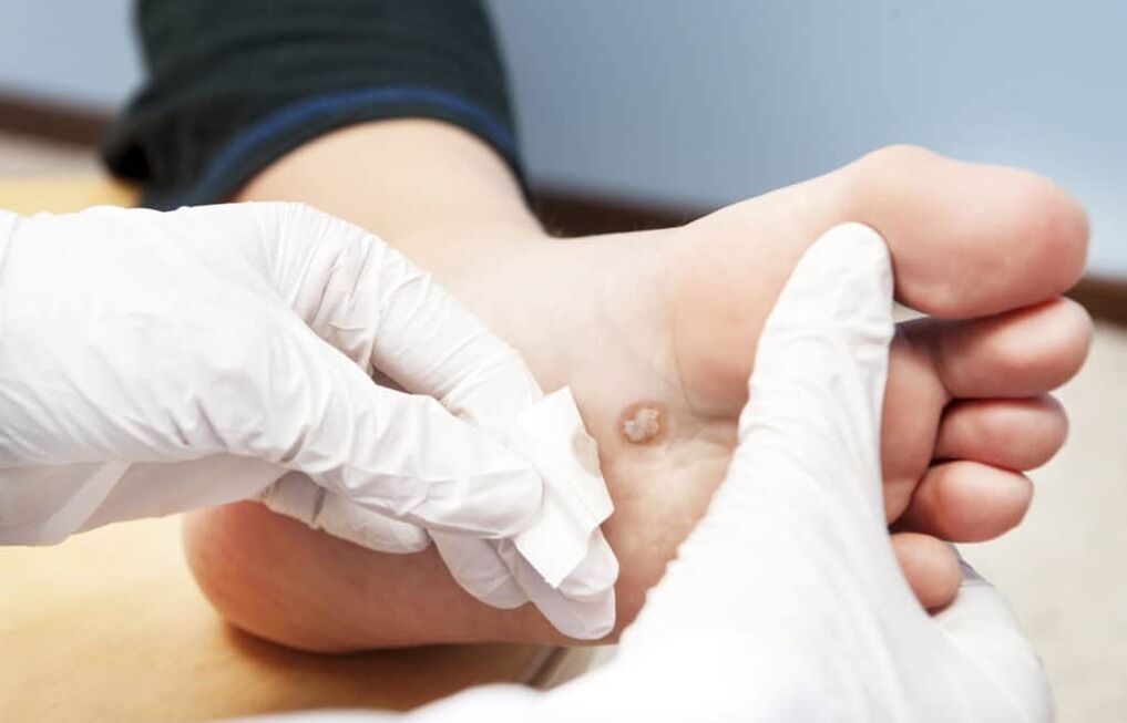 prečo sa na tele objavujú bradavice