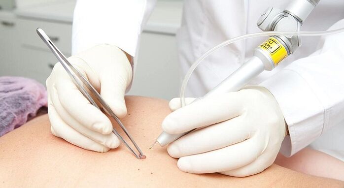 laserové odstránenie papilómu pre papilomavírus