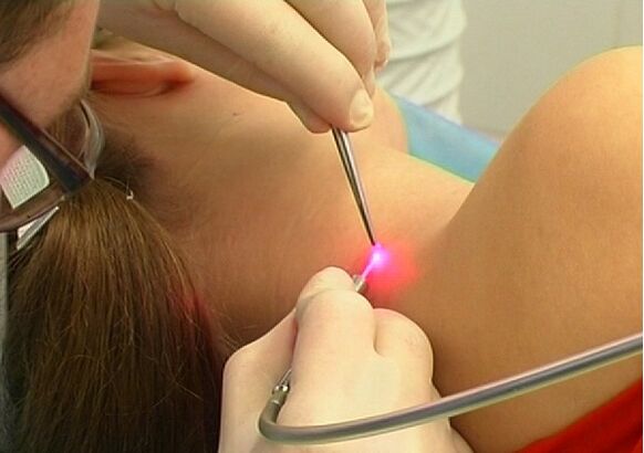 Nízkotraumatická metóda odstraňovania papilómu laserom